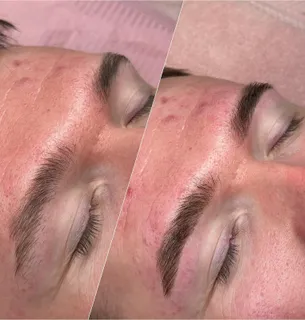Brow treatment